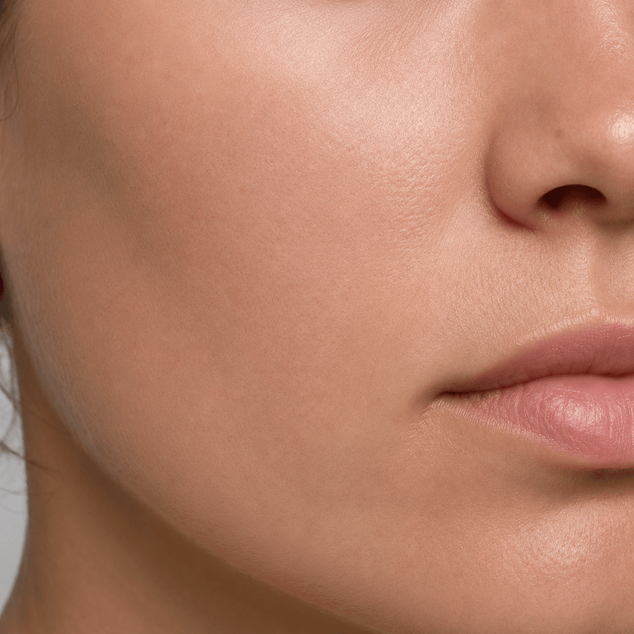 After image showing smoother-looking fine lines and skin texture after a consistent light therapy routine