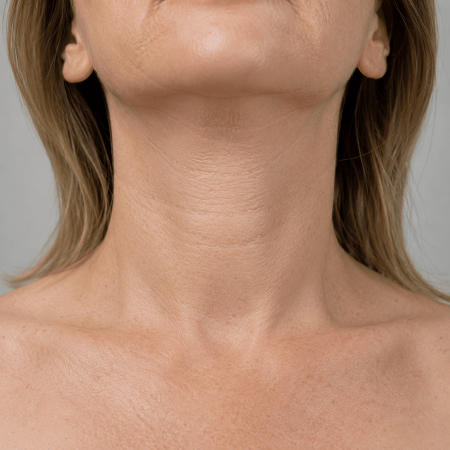 Before image showing visible neck lines before a targeted red light therapy routine
